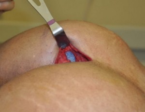 3171723361.images.new_photo.implantis-shekvanis-procesi