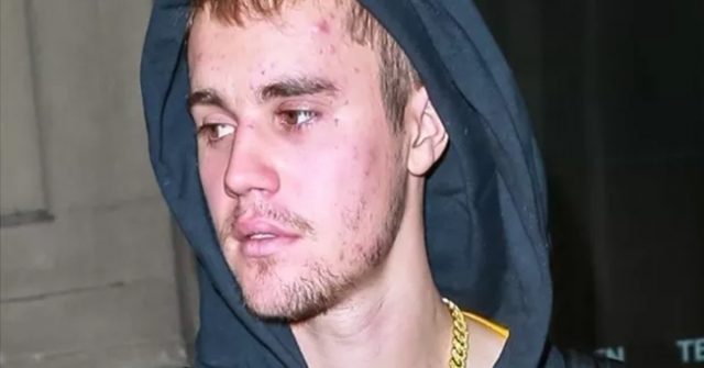 justin-bieber-sofre-com-acne-no-rosto-durante-passeio-em-nova-york